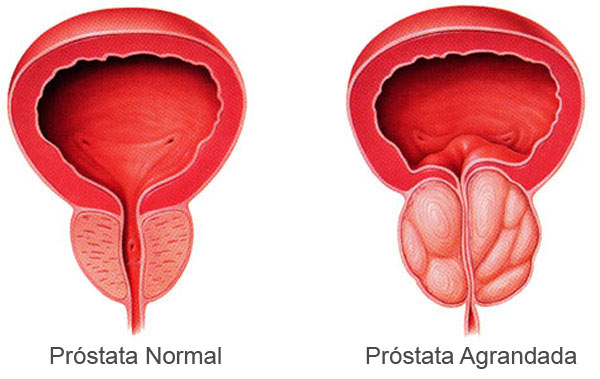 Agrandamiento de la próstata
